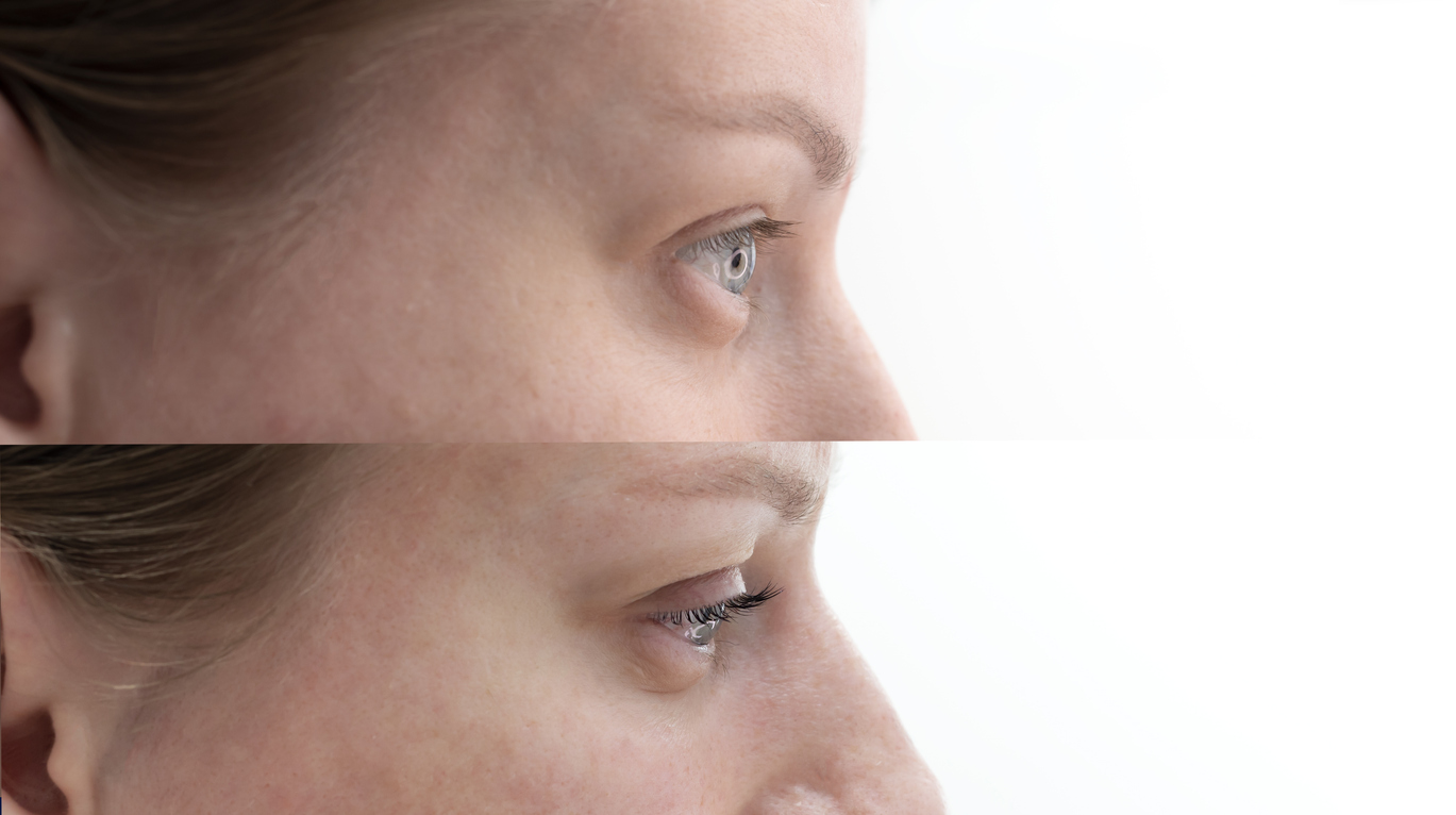 Vorher-Nachher-Beispiel eines Wimpernliftings